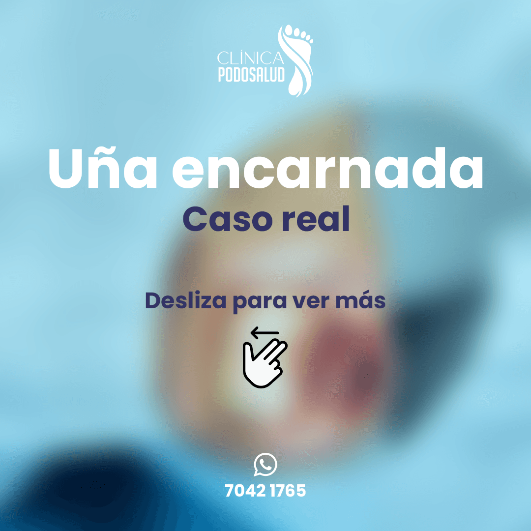 Caso real de uña encarnada 1